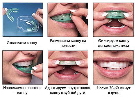 Как сделать чистку зубов в домашних Как сделать чистку зубов в домашних